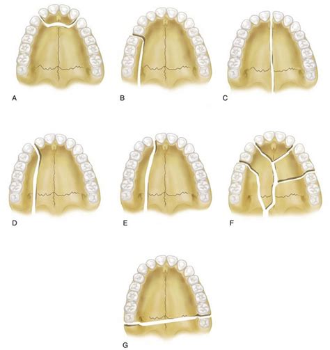 17 Diagnosis And Treatment Of Midface Fractures Pocket Dentistry