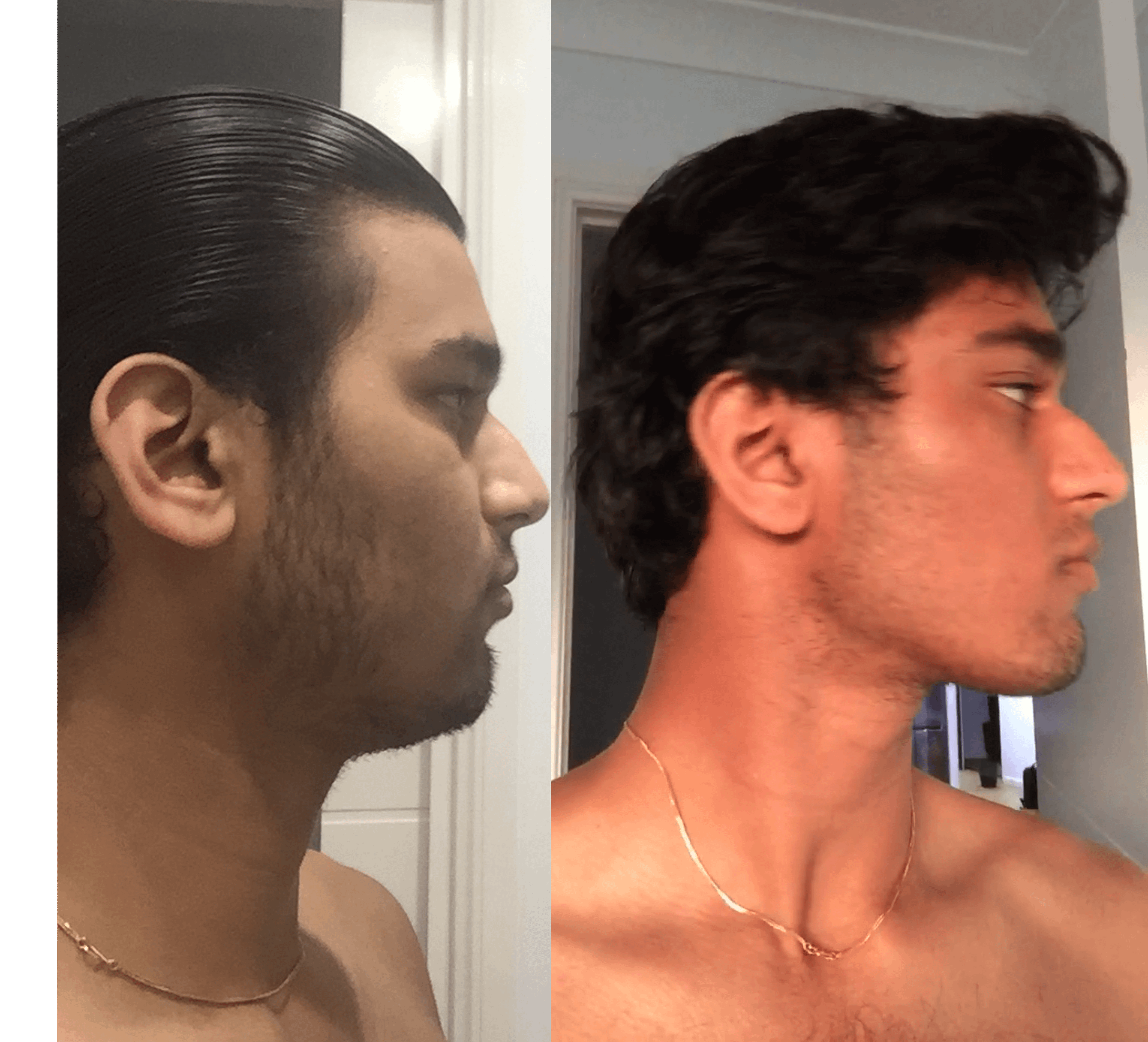 19M 4 Month Mewing 2 Month Chewing Mastic Gum Progress R Mewing
