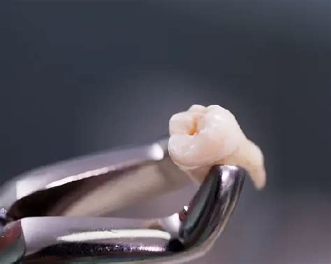 24Hour Emergency Dental Extraction