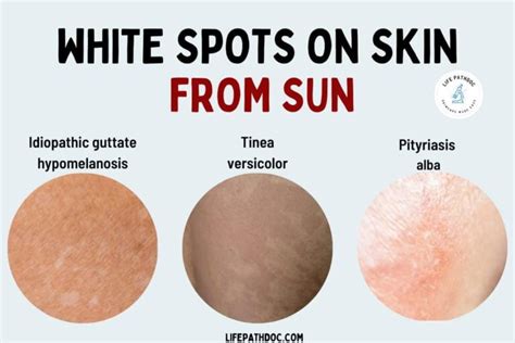 4 Ways To Prevent White Spots On Your Skin From Sun E Vrogue Co