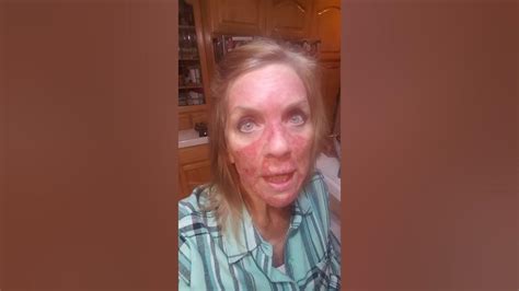 5 Fu Fluorouracil Topical Treatment Day 23 Youtube