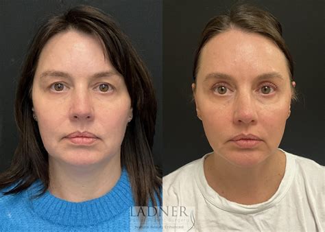 5 Ways To Slim Your Face Ladner Facial Plastic Surgery Keith Ladner Md 5 Ways To Slim Your Face Ladner Facial Plastic Surgery Keith Ladner Md