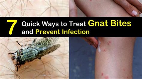 7 Quick Ways To Treat Gnat Bites And Prevent Infection