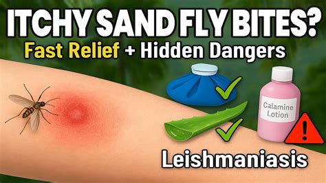 7 Ways To Stop Sandfly Bites Fly Remedies Fly Bites Bitten 7 Ways To Stop Sandfly Bites Fly Remedies Fly Bites Bitten