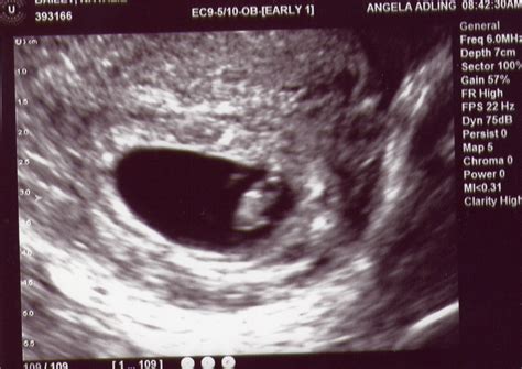 7 Week Ultrasound It S A Little Bean This Was Early Janu