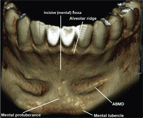 A Volumetrically Rendered Cbct Image Of The Anterior Mandible Showing A Volumetrically Rendered Cbct Image Of The Anterior Mandible Showing