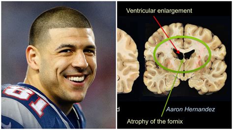 Aaron Hernandez Had Severe Cte Brain Condition