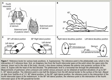 Abbreviations Ics Intercostal Space L Left La Left Atrium R