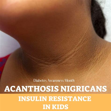 Acanthosis Nigricans Your Black Neck Can Be A Sign Of Diabetes