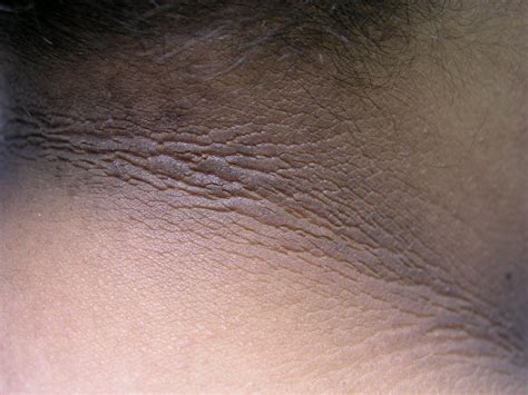 Acanthosis Nigricans