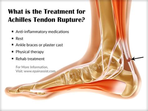 Achilles Tendon Rupture Symptoms Treatment Surgery