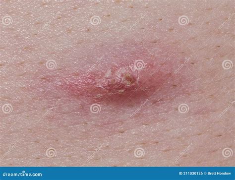 Acne Pimple On Caucasian Skin Beginning To Scab And Heal Over Stock