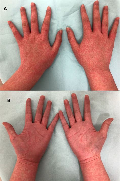 Allergic Reaction To Bactrim Pictures Photos