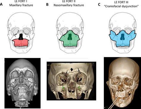 An Extensive Guide To Understanding Lefort Fracture Types And Their