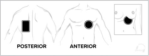 Anteroposterior Placement Of Aed Pads