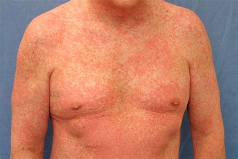 Antibiotic Rash Pictures