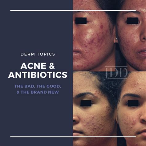 Antibiotics And Acne The Bad The Good And The Brand New Next Steps Antibiotics And Acne The Bad The Good And The Brand New Next Steps