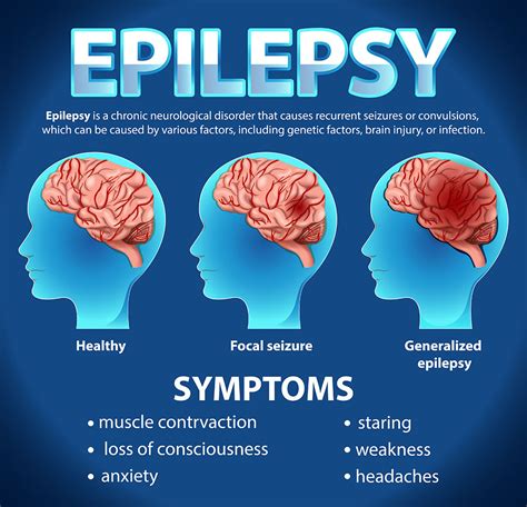 Anxiety And Epilepsy Epilepsy Action