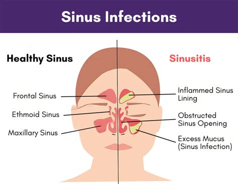 Are Sinus Infections Contagious Diseasefix