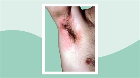 Armpit Rash From Deodorant Causes Diagnosis And Effective Solutions