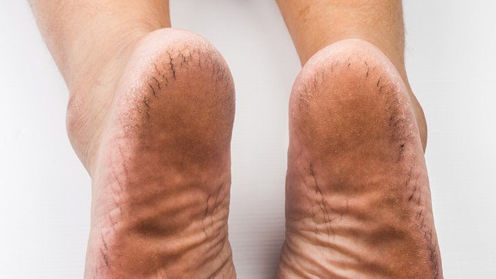 Autoimmune Skin Diseases And Rashes That Affect Appearance Everyday