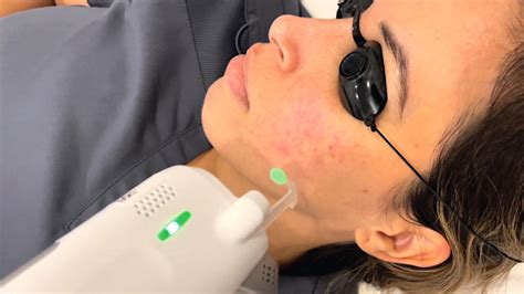 Avissa Skin Laser Skin Tightening