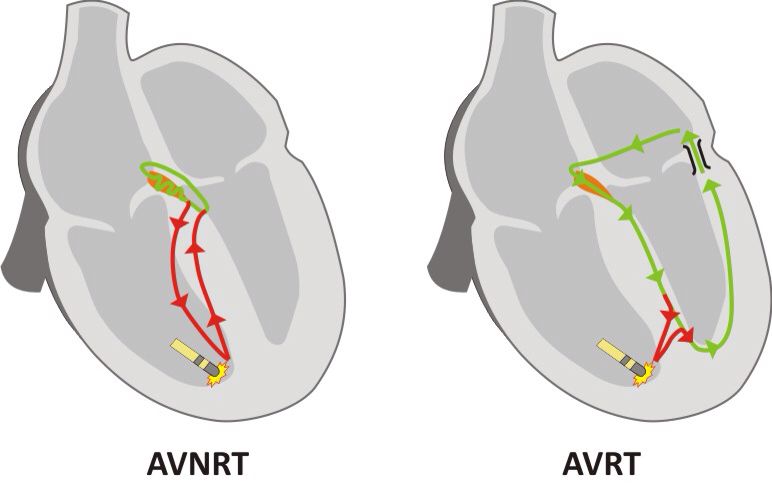 AVNRT vs AVRT Differences Explained