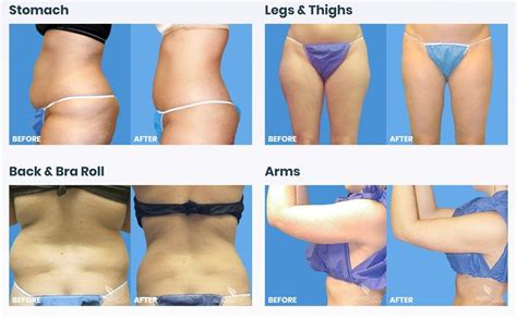 Awake Micro Laser Liposuction Procedure Live Trisculpt Fat Removal Awake Micro Laser Liposuction Procedure Live Trisculpt Fat Removal