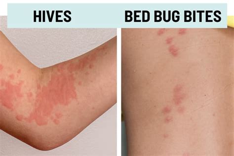 Bed Bug Bites Vs Hives Public Health