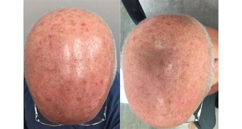 Before After Photos Dermassociates Silver Spring