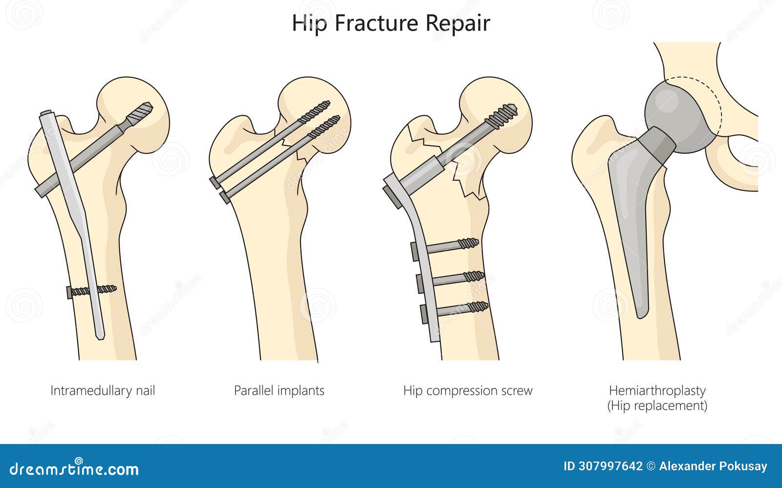 Best Orthopaedic Surgeon For Hip Fracture Bipolar Hip Repair Surgery In