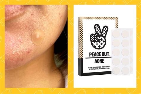 Best Pimple Patch Solution