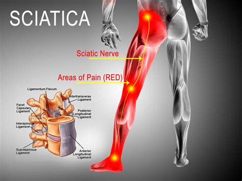 Best Ways To Treat Sciatica Pain Colorado Pain Care