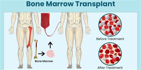 Blood And Bone Marrow Transplant Diagnosis And Treatment Moffitt
