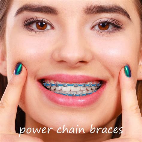 Boost Your Smile with the Power of Braces Power Chain Optimization