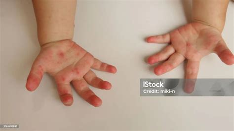 Breaking News Hand Foot And Mouth Disease Outbreak Confirmed At
