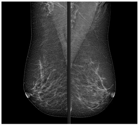 Breast Imaging Advances: Detect Cancer Early!