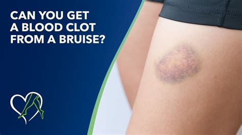 Understanding Bruise Clot: Causes, Symptoms, and Treatment Options