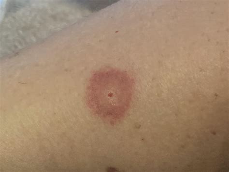 Bug Bite Bruise