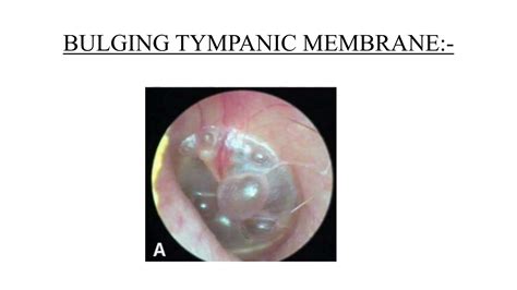 Bulging Tympanic Membrane
