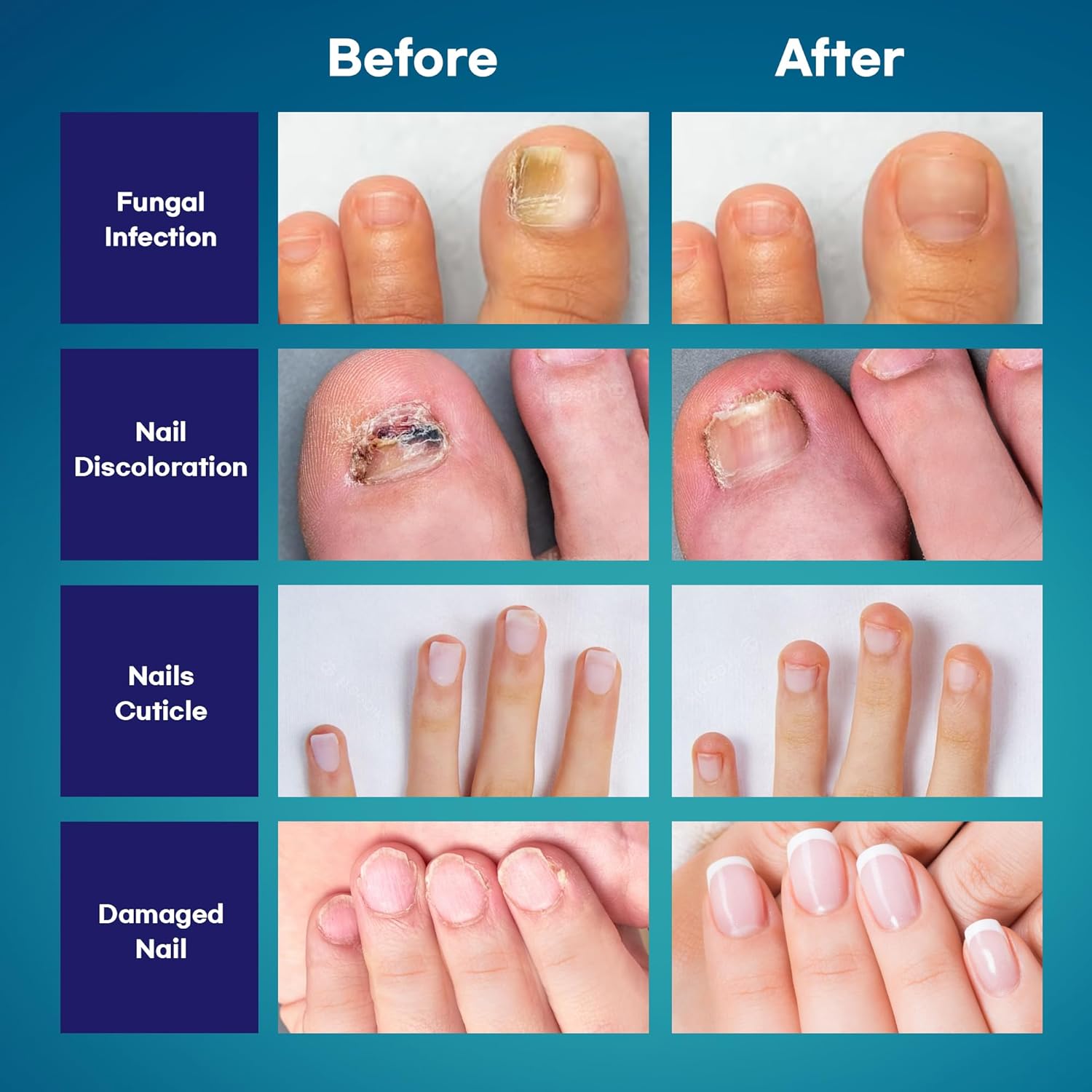 Buy Fungal Nail Treatment Fingernail And Toenail Fungus Treatment