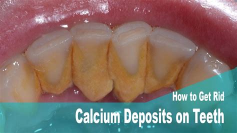 Calcium Deposits On Teeth