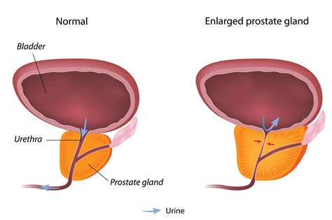 Enlarged Prostate: ED Risk Explained Briefly