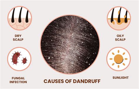 Can Dandruff Cause Hair Loss Causes Of Dandruff Glorashine