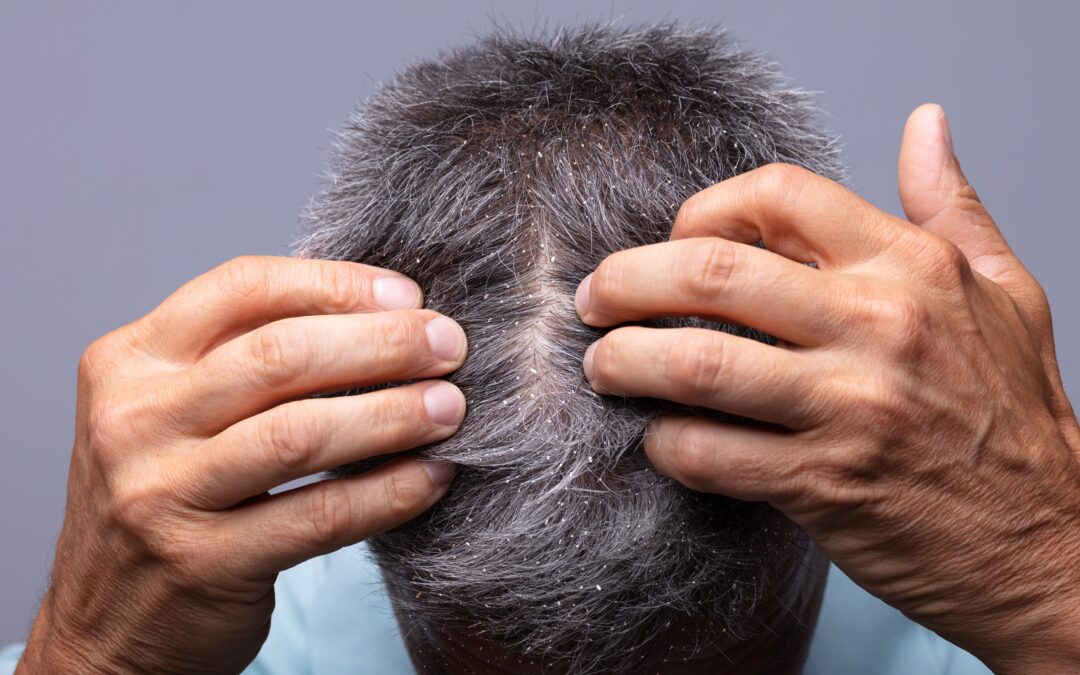 Can Dandruff Cause Hair Loss Orange County