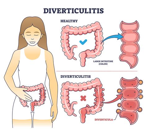 Can Diverticulitis Cause Back Pain