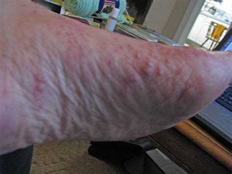 Can You Get Shingles On Foot Outlet Emergencydentistry Com