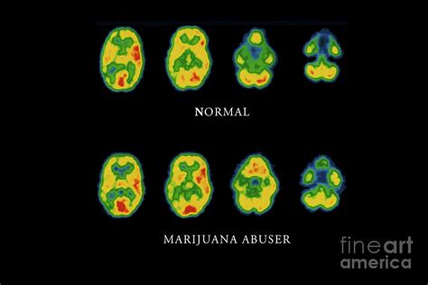Cannabis Brain Scans Photograph By Pascal Goetgheluck Science Photo Cannabis Brain Scans Photograph By Pascal Goetgheluck Science Photo