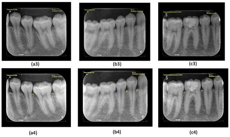 Carcinoma Mistaken For Periodontal Disease Importance Of Careful Consideration Of Clinical And Radiographic Findings Oral Surgery Oral Medicine Oral Pathology And Oral Radiology