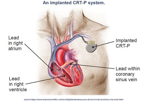 Cardiac Resynchronization Therapy Crt Devices Patient Information Cardiac Resynchronization Therapy Crt Devices Patient Information
